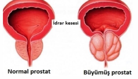 İyi Huylu Prostat Hastalıkları