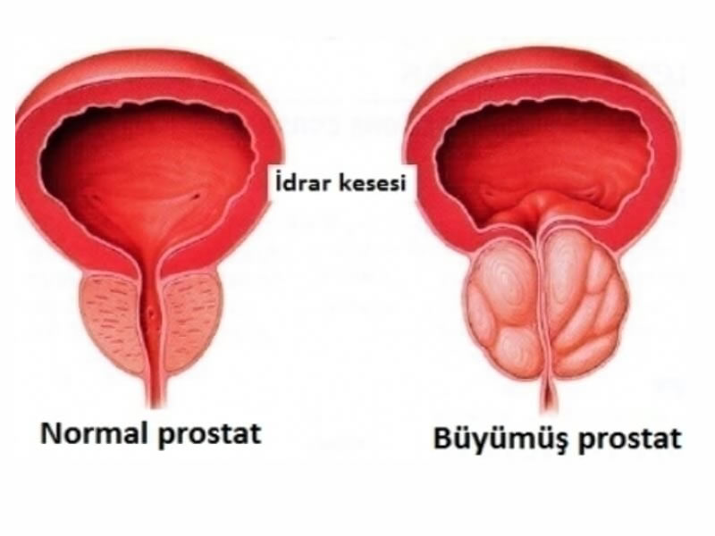 İyi Huylu Prostat Hastalıkları