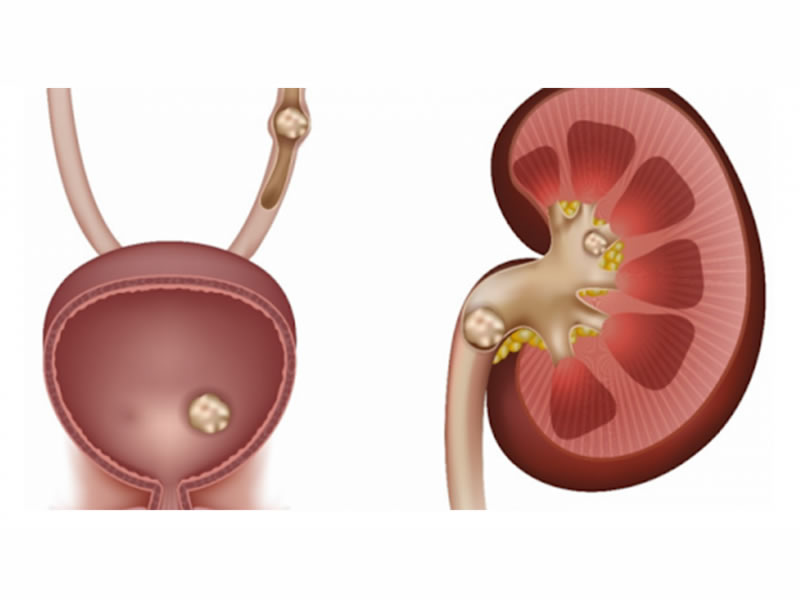 Üriner Sistem Taş Hastalıkları